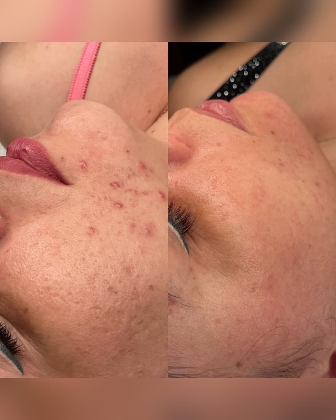 Facial Purificante para Acné