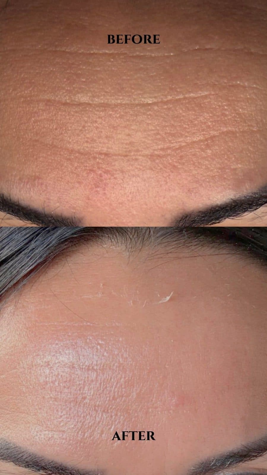 Microneedling Premium Regenerative