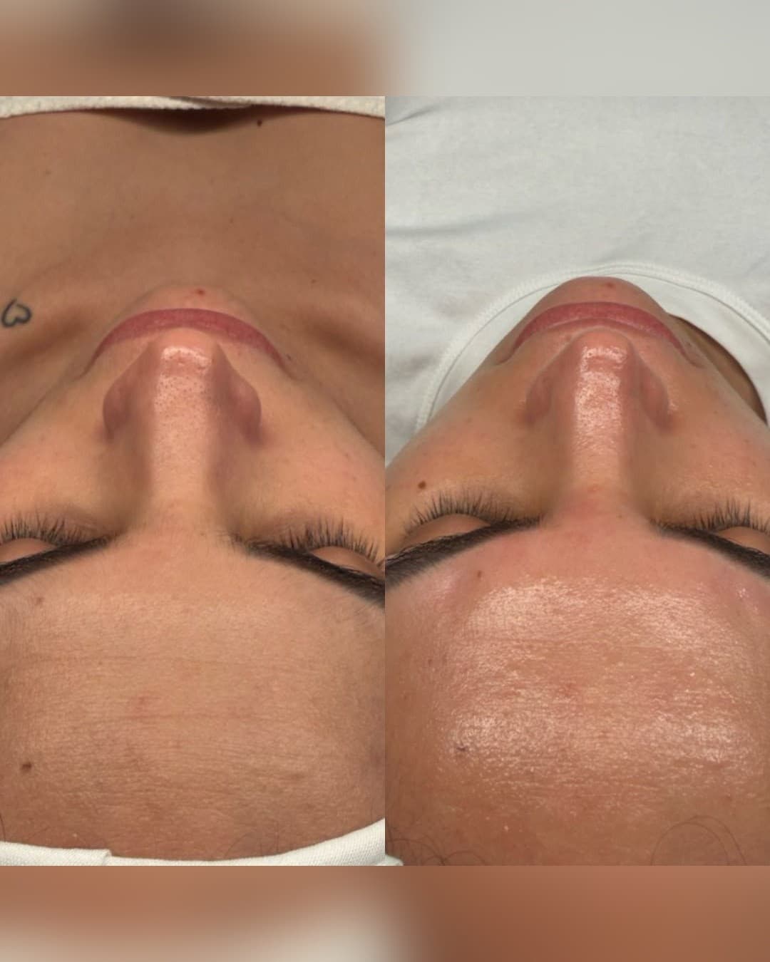 Peeling Químico Personalizado